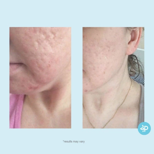 Glycolic 50% Gel Peel- kwas glikolowy 50% w żelu 30 ml