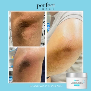 Revitaboost Peel™- mieszanina kwasów w padach 30 sz.