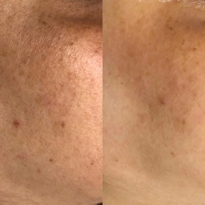 Hydro-Glo™ Peel- mieszanina kwasów w padach 30 sz.
