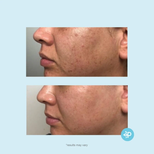 Revitaboost Peel™- mieszanina kwasów w padach 30 sz.