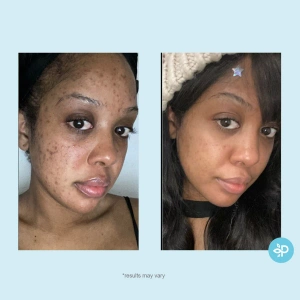 Perfect Image - Salicylic 10% Clarifying Gel Peel (LEVEL R)