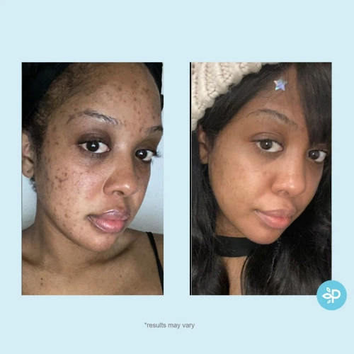 Perfect Image - Salicylic 10% Clarifying Gel Peel (LEVEL R)