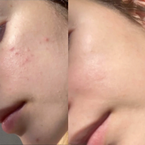 Perfect Image - Lactic 10% Brightening Gel Peel (LEVEL R)