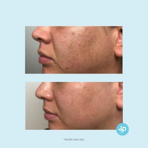 Revitaboost Peel™- mieszanina kwasów w padach 30 sz.