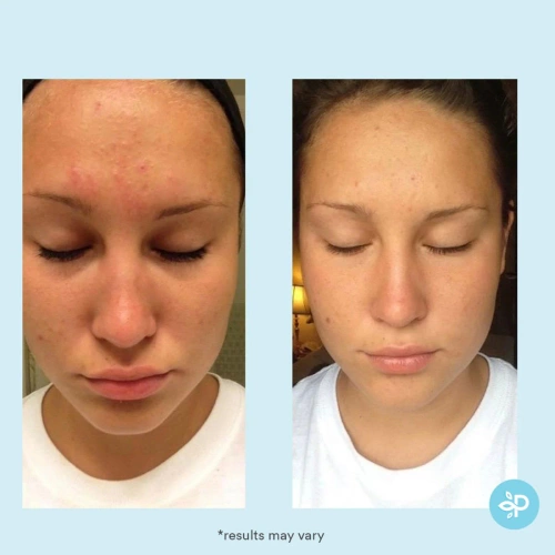 Glycolic 30% Gel Peel- kwas glikolowy 30% w żelu 30 ml