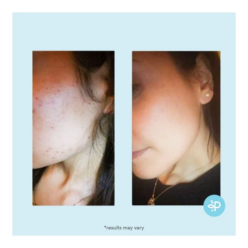 Salicylic 20% Gel Peel- kwas salicylowy 20% w żelu 30 ml