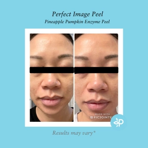 Perfect Image - Pineapple Pumpkin Enzyme Peel (LEVEL R)
